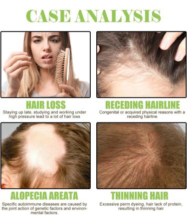 Utapossin Hair growth shampoo antihair loss shampoo hair growth and conditioner against hair loss for faster hair regrowth prevents hair loss - Buy Online on GoSupps.com