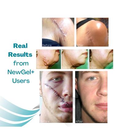 NewGel+ Advanced Silicone Scar Treatment Sheets for Breast Reconstruction Surgery Anchor Scars - 4-Count, Clear - Buy Online on GoSupps.com