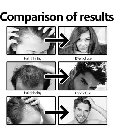 Hair Growth Serum Organic Castor Oil Anti Hair Loss Hair Serum for Thinning Balding Thin Hair Fast Growth Strengthen Hair Roots for Men & Women Damaged Hair Repair - Buy Online on GoSupps.com