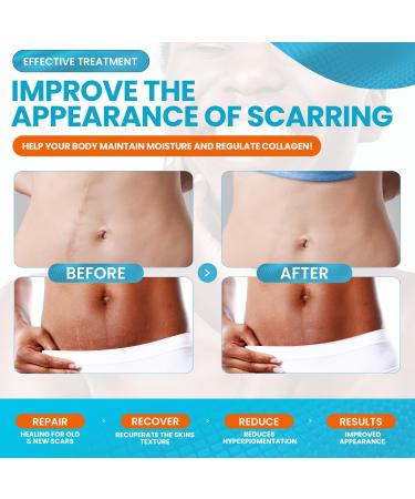 WONDERSCAR 10 Large Silicone Scar Sheets - Medical Grade Treatment for Keloid, C-Section, Burn, Stretch Marks & Acne - Reusable Gel Strips for Scar Removal - Buy Online on GoSupps.com