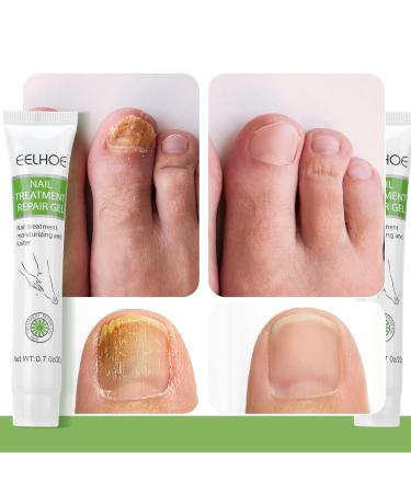 Floepx Nail Repair Gel - 2 PCs Nail Care Treatment for Cracked Rough Nails & Discoloration - Protect & Repair Your Toenails - Buy Online on GoSupps.com
