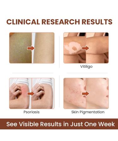 Vitiligo Care Ointment 20g | Repigmentation & Relief Cream | Improves Skin Pigmentation | Easy to Apply | 5-Pack - Buy Online on GoSupps.com