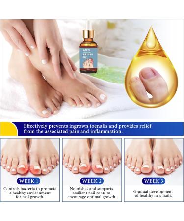 Ingrown Toenail Treatment 30ml Ingrowing Toenail Treatment Toenail Anti Paronychia Relief Oil Correction Ingrown Toenail Softening Drops for Damaged Discolored Thick Nail - Buy Online on GoSupps.com