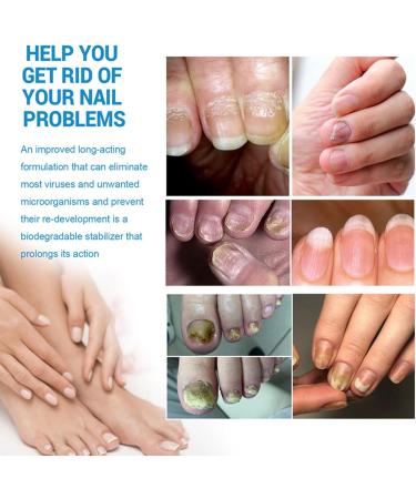 GkgWuxf Nail StrengtheningFoot Nail Nourishing Spray 100ml Nonsticky Strengthening Spray for Damaged Cracked Brittle Nails for Daily Hand and Foot Care - Buy Online on GoSupps.com