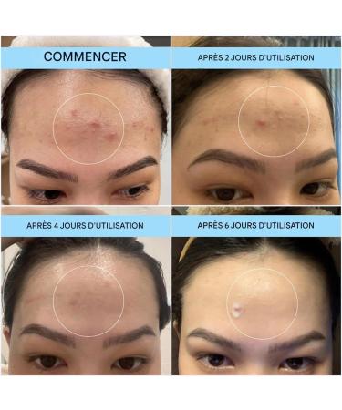  Pruojhw Spot Treatment Gel - Fast-Absorbing Easy-to-Apply Non-Greasy Blemish Eliminator - Anti-Pimple Facial Gel - For Women Girls Family Friends Colleagues - Buy Online on GoSupps.com