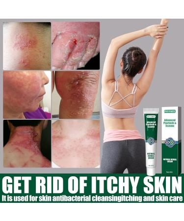 Antifungal Cream:Jock Itch Cream Soothing Eczema Relief Cream All-Natural Soothing Care & Fast Relief of Jock Itch Eczema Psoriasis - Ringworm Treatment for Humans - for Adults and Kids - Buy Online on GoSupps.com