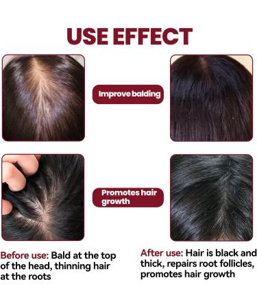 JITASHWA Hair Growth Foam Hair Regrowth Treatment for Women & Men Hair Regrowth Scalp Foam Hair Loss Solution Hair Thickening Product - Buy Online on GoSupps.com