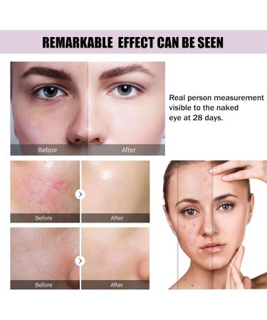 30% AHA+ 2% BH_A Face Serum BH_A Exfoliating Solution Target Breakouts by Helping to Reduce Blemishes Pores & Blackheads for A Cleaner More Radiant Complexion - Buy Online on GoSupps.com