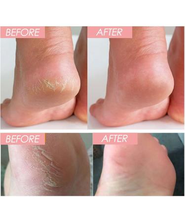 Cracked Heel Repair Cream Stick Foot Moisturizing Stick Foot Cream For Very Dry Feet Foot Cream For Calluses And Hard Skin Foot Moisturiser Callus Remover Soften For Feet Knees Hand - Buy Online on GoSupps.com