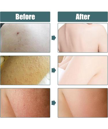  GAESHOW Keratosis Pilaris Cream Exfoliating Body Scrub 50g Soothing Keratosis Pilaris Body Cream for Treating Pimples and Sensitive Skin - Buy Online on GoSupps.com