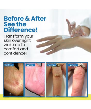 Dermasolve Full Body Eczema Relief Lotion Cream - Flare Control Therapy Balm That Protects, Moisturizes, and Repairs Skin Kids, Babies & Adults - Steroid Free (4 Fl Oz, 1) 4 Fl Oz (Pack of 1) 4.0 - Buy Online on GoSupps.com