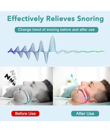 Anti Snoring Mouthpiece - Effective Snoring Solution for Men and Women - Buy Online on GoSupps.com