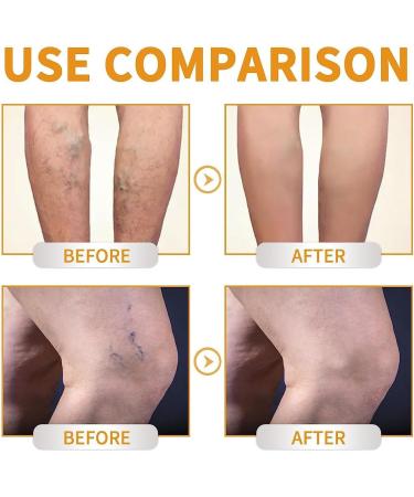RWRAPS 2STK Fivfivgo Varicose Vein Miracle Cream - Improve Blood Circulation & Relieve Leg Discomfort - Buy Online on GoSupps.com