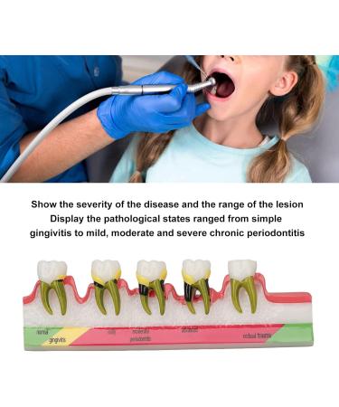 Dental Parodontitis Model - Visualize Stages & Improve Communication Between Dentists and Patients | International Shipping - Buy Online on GoSupps.com