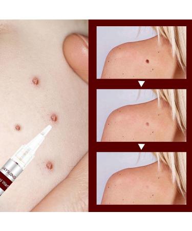 2pcs Wipeoff Pen for Tags & Moles Remover | Quick & Effective Natural Solution - Shop Internationally! - Buy Online on GoSupps.com