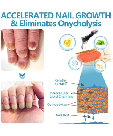 Nail Growth and Repair Serum Nail Strengthening and Growth Conditioner Nourish Strengthen And Revitalize Your Nails (1 Pcs) - Buy Online on GoSupps.com