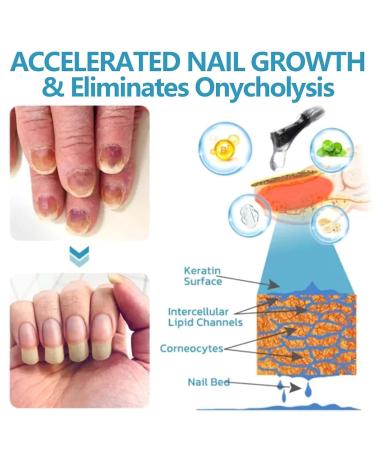 Onyxoguard Nail Growth Serum - Strengthen & Repair Thin Brittle Nails | Crystal Clear Base Coat Treatment - Buy Online on GoSupps.com