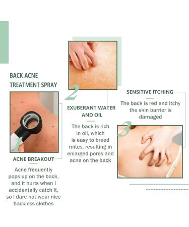 Acne Treatment Spray Lighten Acne Marks Skin Care Spray Herbaluxy Back Acne Treatment Body Moisturiser For Dry Skin Repair Back Shoulder Acne & Body Acne & Chest Acne & Butt Acne Gentle - Buy Online on GoSupps.com