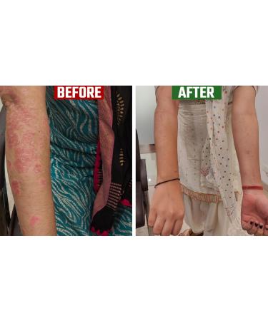 Psoria Oil - Ayurvedic Treatment for Natural Relief | 200 ml - Natural Ingredients for Psoriasis Care - Buy Online on GoSupps.com