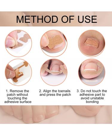 Ilamvie Ingrown Toenail Correction Set - 112 Piece C-Shaped Fill Padding Tool for Easy Ingrown Toenail Treatment - Buy Online on GoSupps.com