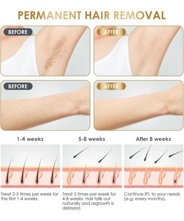 IPL Laser Hair Removal Device for At-Home Use | Permanent Painless Hair Removal for Women & Men - Ideal for Face Bikini Armpits & Full Body | NATRSYM JZF - Buy Online on GoSupps.com