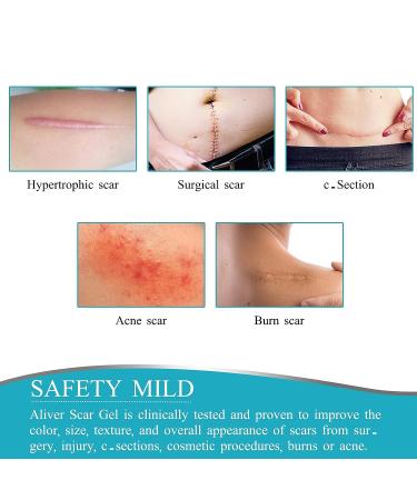 Hao Silicone Scar Remover Tape 1.6 x 120 Roll - 3ml | Medical Soft Silicone Scar Sheets for Surgery Scars - Easy-Tear Tape for Scar Removal (Blue) - Buy Online on GoSupps.com