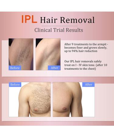 MiSMON IPL Hair Removal: Permanent Hair Removal for Women/ Men - At-Home Hair Removal Machine for Bikini, Legs, Underarm, Arm, Body - Safe & Effective - Buy Online on GoSupps.com
