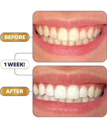 Lumineux Teeth Whitening Strips - 7 Treatments, Dentist Approved, Non-Toxic & Sensitivity-Free | Whiter Teeth in 7 Days - Buy Online on GoSupps.com