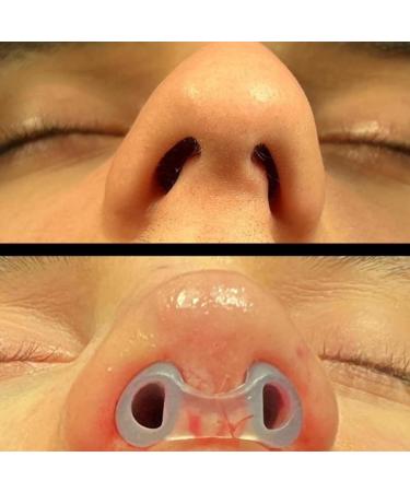 Nostril Retainer Short Model - Ideal for Rhinoplasty Recovery | 100% Silicone Nose Support System - Buy Online on GoSupps.com
