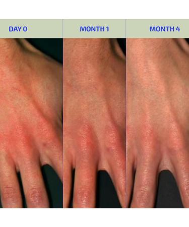 Codex Labs BIA Eczema Relief Lotion 3.4 oz - Clinically Proven Colloidal Oatmeal 1% for Itchy Dry Eczema Prone Skin - Fragrance Free Moisturizer with BiaComplex 2.0 - Safe for Babies Kids & Adults - Buy Online on GoSupps.com