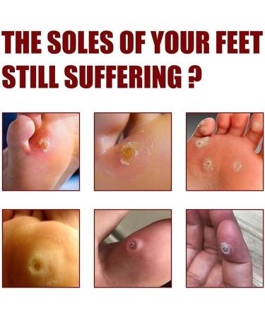 Extra Strong Foot Chicken Removal Gel - Effective Chicken Eye Remover for All Skin Types | Premium Foot Care Solution (1 Piece) - Buy Online on GoSupps.com