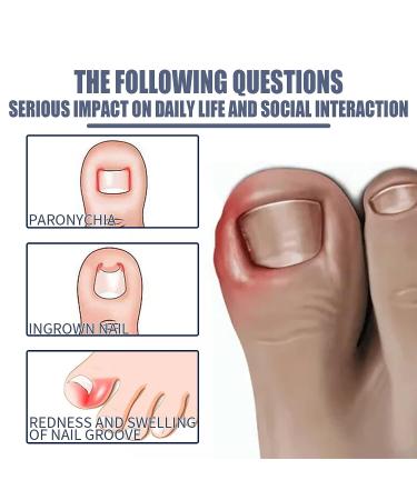 Paronychia Oil for Ingrown Toenail Treatment - Nail Renewal Liquid for Damaged Nails (2 Pcs) - Buy Online on GoSupps.com