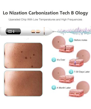 Skin Tag Removal Pen | Portable Mole & Wart Remover Tool with 9 Strength Levels | LED Display & Light | Home Use Spot & Freckle Removal - Buy Online on GoSupps.com