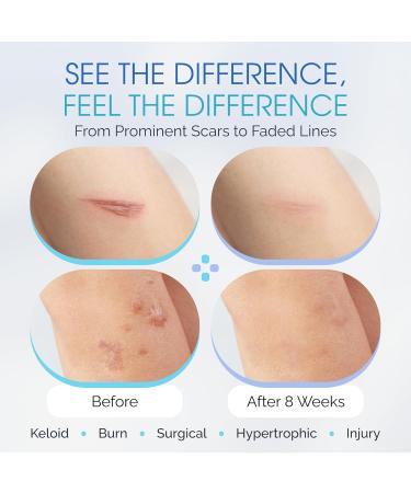 Medical Grade Silicone Scar Sheets - Large 7 Water Resistant & Reusable - Breathable Clear Tape for C-Section Tummy Tuck Surgical Scars & Keloids - 4 Strips & 4 Sheets - Buy Online on GoSupps.com