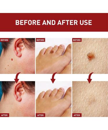 Aibyks 2 Skin Tag Corrector | Natural Mole Remover Cream Natural Skin Tag Removal Mole Corrector for Face Wart and Body Wart - Buy Online on GoSupps.com