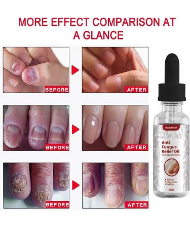 Quick Relief Oil Fungal Nail Treatment Rapid Relief Oil Nail Fungus Treatment For Toenail Nail Treatment Oil Toe Nail Fungal Treatment Onychomycosis Nail Treatment Toenail Repair for Damaged Nails - Buy Online on GoSupps.com