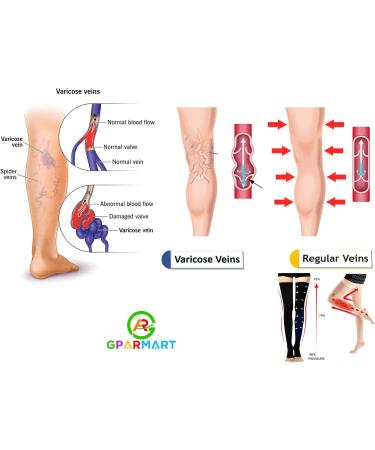 GPAR Premium Open Toe Compression Stockings Class 2 - 23-32 mmHg for Varicose Veins & Leg Pain - Unisex XXL Black - Buy Online on GoSupps.com