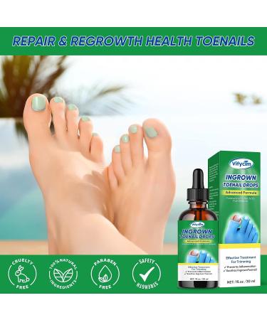 Ingrown Toenail Treatment Drops - Fast Acting Pain Relief & Softener 30ml - Buy Online on GoSupps.com