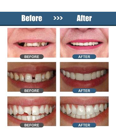 Temporary Tooth Repair Kit | Modable False Teeth & Filler Granules | Fake Teeth & Missing Tooth Fix | Dental Repair Beads - Buy Online on GoSupps.com