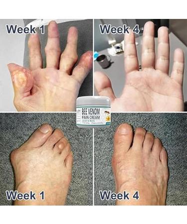 Plebolo Bee Venom Pain and Bone Healing Cream Bee Venom Joint and Bone Relief Cream New Zealand Joint and Bone Therapy Cream Bee Venom Pain Relief Cream for Back Neck Hands Feet (3pcs) - Buy Online on GoSupps.com