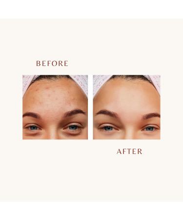 SkinPhoria Red Blood Facial Peeling AHA, PHA & BHA Face Serum for Clear, Smooth Skin Niacinamide & Salicylic Acid Helps Reduce the Look of Post-Acne Marks Brightens Complexion 30ml - Buy Online on GoSupps.com