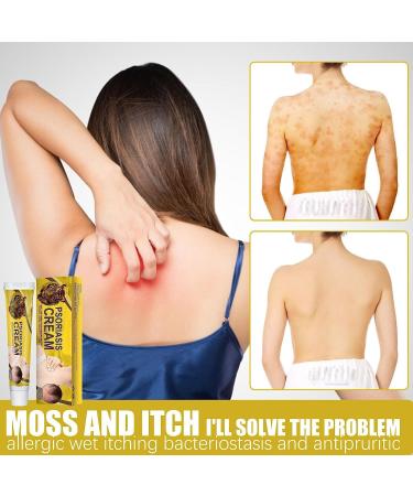 Doxenem Eczema & Psoriasis Cream - Control Reoccurrence, Tinea Versicolor Treatment, Dark Spots Relief for Adults - Buy Online on GoSupps.com