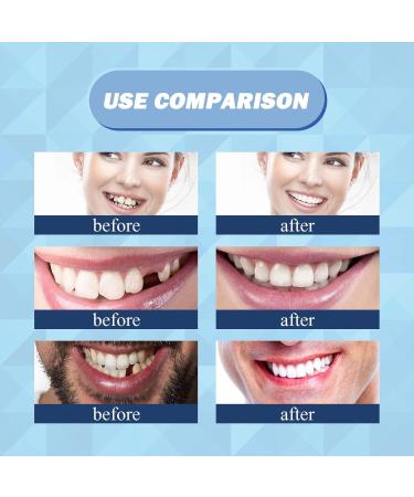 30 ml Tooth Repair Kit | Temporary Tooth Replacement & Moldable Thermal Fitting Beads for Missing Broken Teeth & Dentures - Buy Online on GoSupps.com