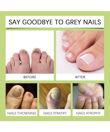  Generisch Nail Care & Nail Care | 15ml Essence Liquid Solution for Nail Repair - Effective Essence for Brittle Nails and Finger Nail Cracks - Buy Online on GoSupps.com