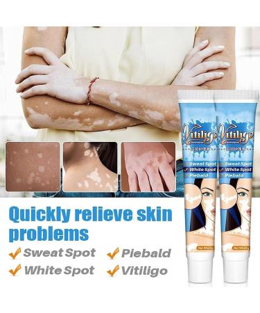 Vitiligo Therapy Cream: Soothing Ointment to Reduce White Spots & Improve Skin Pigmentation - Buy Online on GoSupps.com