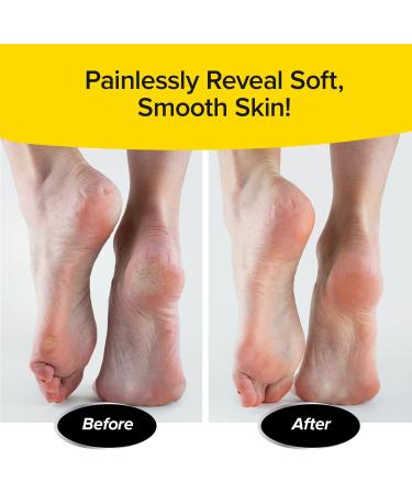 Ped Egg Classic Callus Remover | As Seen On TV | Safely Remove Tough Calluses & Dry Skin | 135 Precision Micro-Blades | Mess-Free | White - Buy Online on GoSupps.com