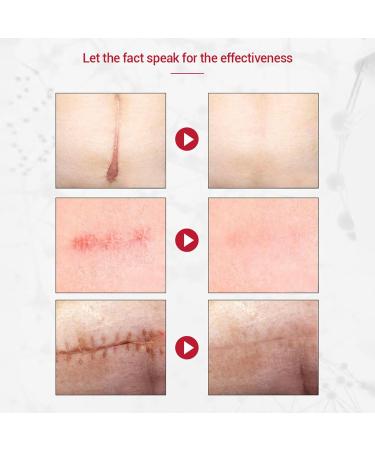  Fyearfly Scar Removal Gel 1.1 oz Scar Repair Gel Cleansing Soothing Nourishing Scars Burns Cuts Gel for Damaged Skin - Buy Online on GoSupps.com