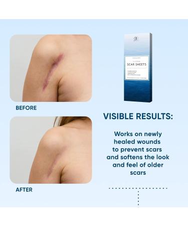Silicone Scar Removal Sheets - Reusable & Waterproof Patches for C-Section, Burn, Acne, Stretch Marks - 4 Sheets - Buy Online on GoSupps.com