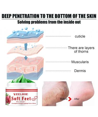 Regenerating Foot Cream for Firing (Rhagaden) Treatment - Heal Cracked Skin on Hands Elbows & Feet | International Shipping Available - Buy Online on GoSupps.com