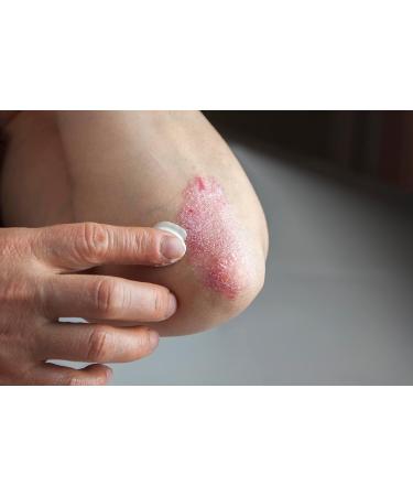 Psoriasis Treatment Gel - Advanced Relief for Flaking & Irritation - Hydrating Soothing Non-Greasy Formula - Fast-Absorbing 2 oz | International Shipping Available - Buy Online on GoSupps.com